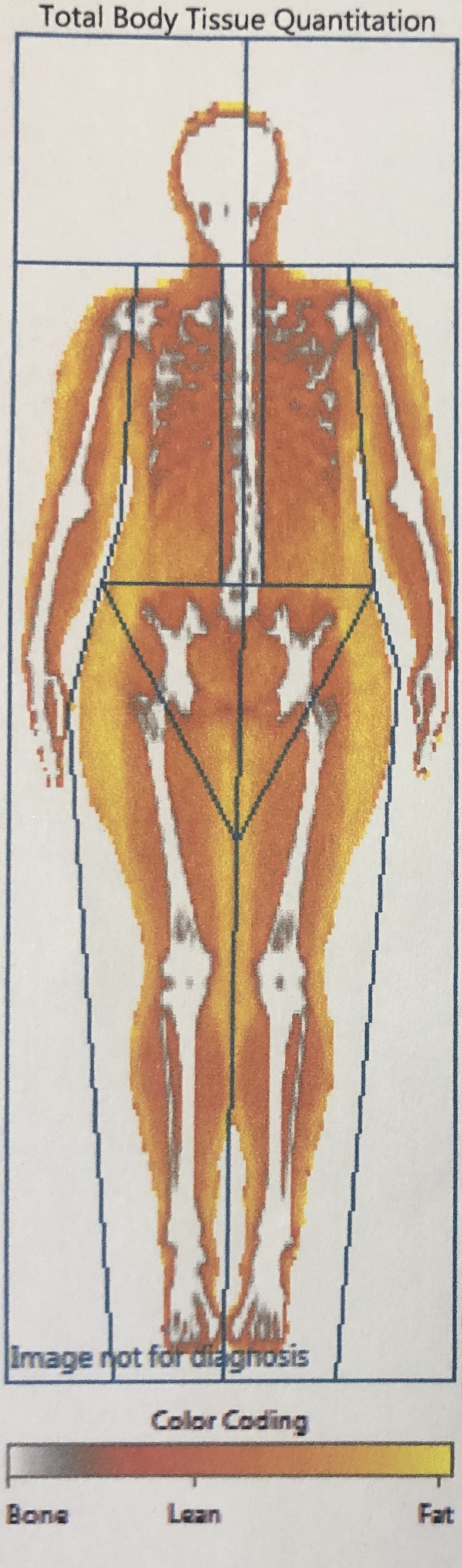 DXA Scan Body Composition